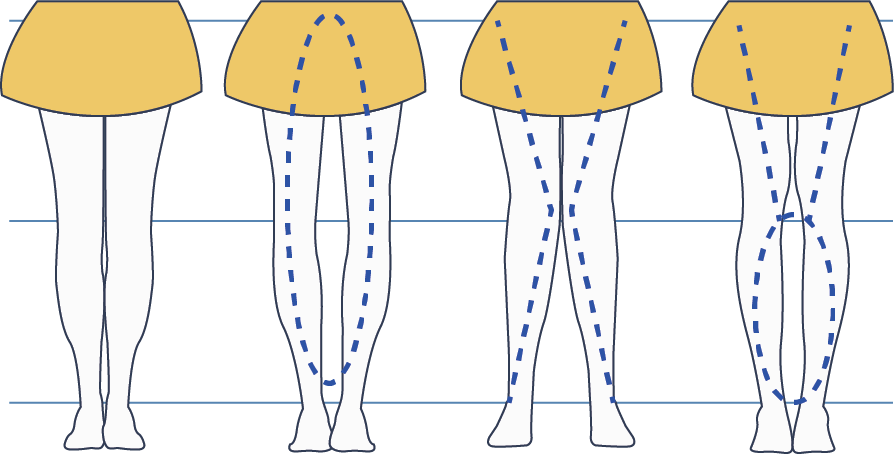 휜 다리 일러스트